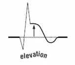 ST-elevation