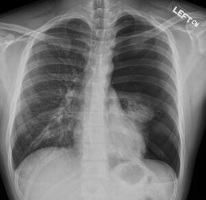 Pneumothorax Medicin Wiki