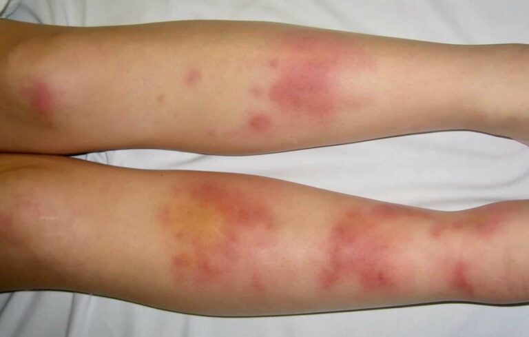 Erythema Nodosum Medicin Wiki